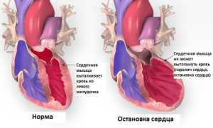 Остановка сердца: причины и алгоритм первой помощи