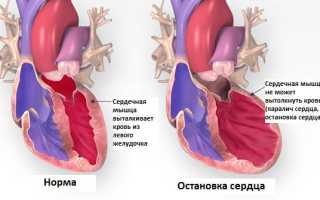 Остановка сердца: причины и алгоритм первой помощи