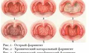 Острый и хронический фарингит