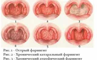 Острый и хронический фарингит