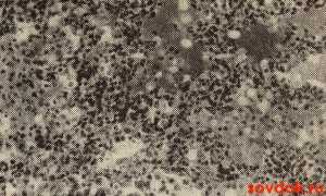 Новые подходы к патогенезу, диагностике и лечению очаговых пневмоний