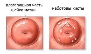 Наботовы кисты шейки матки
