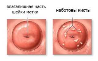 Наботовы кисты шейки матки