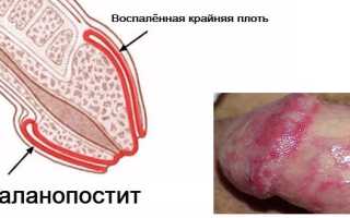 Баланит и баланопостит: способы лечения и рекомендации