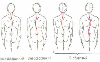 Cколиоз у детей: как вылечить заболевание