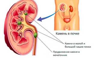 Литотрипсия: как проводится процедура и чем она хороша