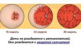 Ретинопатия недоношенных — как сохранить малышу зрение
