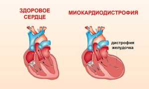 Дегенерация миокарда: симптоматика, диагностика и лечение