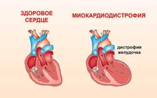 Дегенерация миокарда: симптоматика, диагностика и лечение
