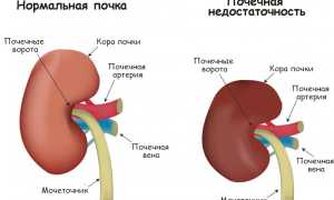 Хроническая почечная недостаточность: что собой представляет и как её побороть