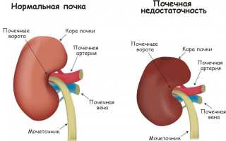Хроническая почечная недостаточность: что собой представляет и как её побороть