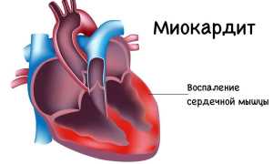 Как развивается миокардит, симптомы и лечение патологии