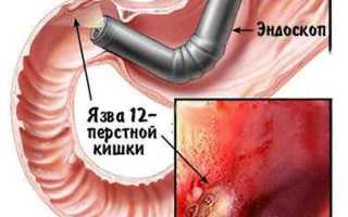 Методы диагностики язвенной болезни и принципы подбора адекватного лечения