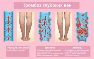 Что делать, если ноги тянет