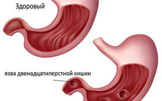 Атрофический  гастрит  и риск  развития  рака  желудка?