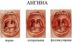 Катаральная ангина у детей: особенности заболевания и методы лечения