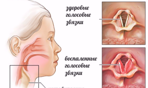 Ларингит у грудных детей: когда «промедление — смерти подобно»
