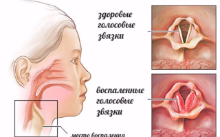 Ларингит у грудных детей: когда «промедление — смерти подобно»