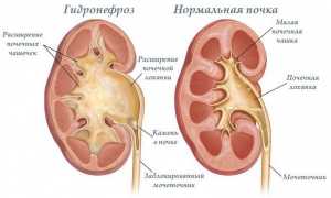 Гидронефроз левой почки: как справиться с патологией