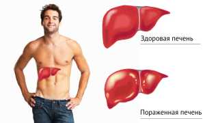 Алкогольный гепатит: как распознать и вылечить патологию