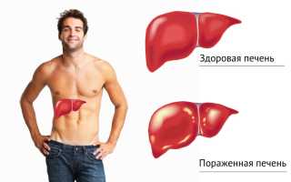 Алкогольный гепатит: как распознать и вылечить патологию