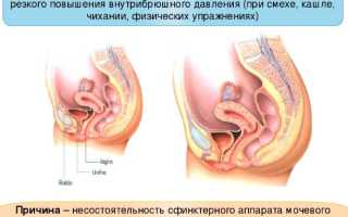 Стрессовое недержание мочи у женщин: решаем деликатную проблему