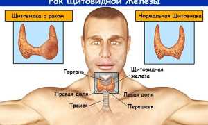 Почему может быть опасен узел щитовидной железы: медуллярный рак