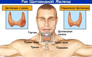 Почему может быть опасен узел щитовидной железы: медуллярный рак