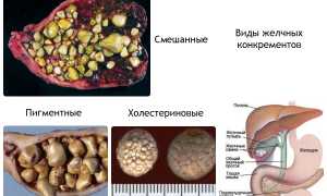 Заболевания  печени  и  желчного пузыря  при  воспалении  кишечника