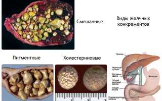 Заболевания  печени  и  желчного пузыря  при  воспалении  кишечника