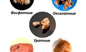 Способы дробления почечных камней: возможности современной медицины