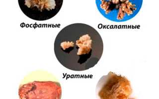 Способы дробления почечных камней: возможности современной медицины