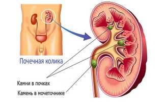 Как помочь при почечной колике в домашних условиях