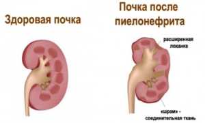 Беременность и пиелонефрит, или как родить здорового ребёнка