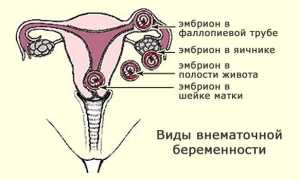 Клинические проявления внематочной беременности