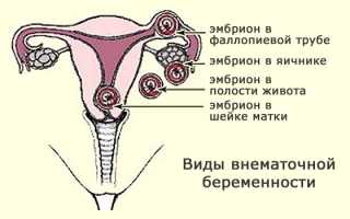 Клинические проявления внематочной беременности