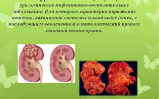 Гломерулонефриты и пиелонефриты: сходства и отличия