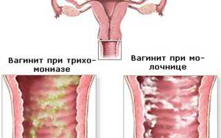 Острый вагинит: обнаружить и устранить