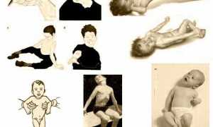 Мышечная дистония у детей и взрослых: как справиться с заболеванием