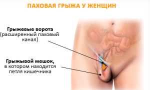 Лечение паховой грыжи у женщин