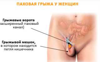 Лечение паховой грыжи у женщин