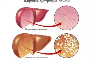 Жировая дистрофия печени
