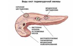 Что такое киста на поджелудочной железе, чем она опасна и как ее лечить