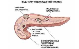 Что такое киста на поджелудочной железе, чем она опасна и как ее лечить