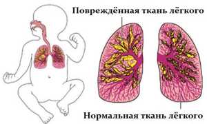 Пневмония у новорождённых — большая угроза для самых маленьких