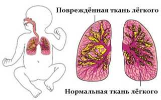 Пневмония у новорождённых — большая угроза для самых маленьких