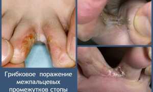 Микозы  стоп:  причины,  клинические  проявления, тактика лечения