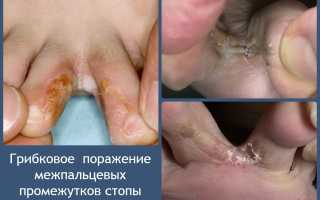 Микозы  стоп:  причины,  клинические  проявления, тактика лечения