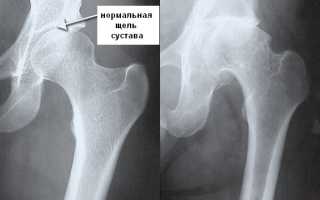 Комплексные   диагностические  методы выявления  коксартроза  у  детей