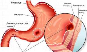 Лучшие народные средства для лечения язвы желудка